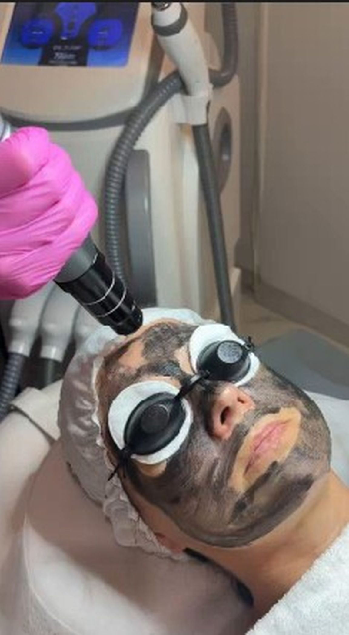 Peeling węglowy – przebieg zabiegu