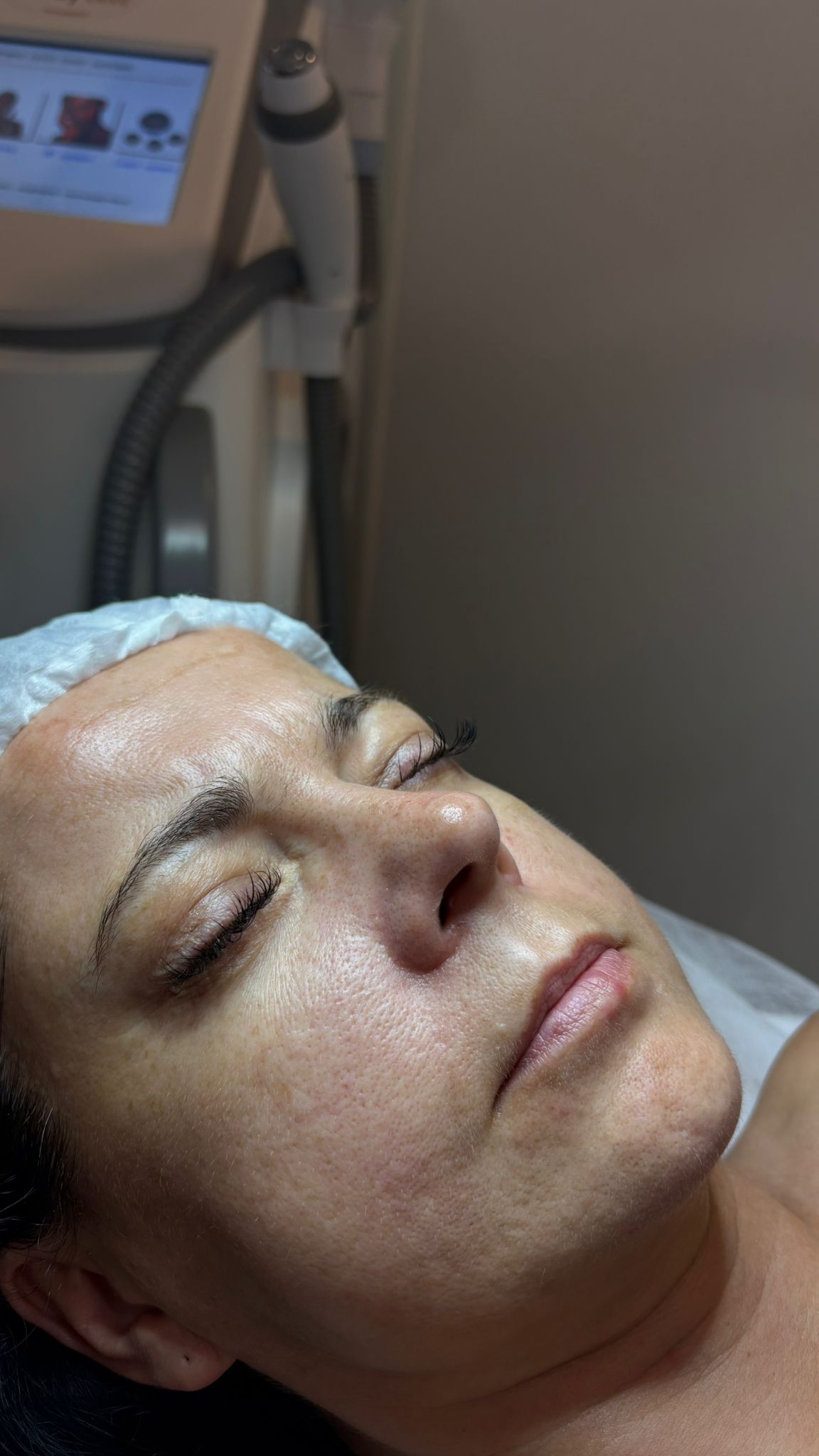 Skóra przed peelingiem węglowym (carbon peel)